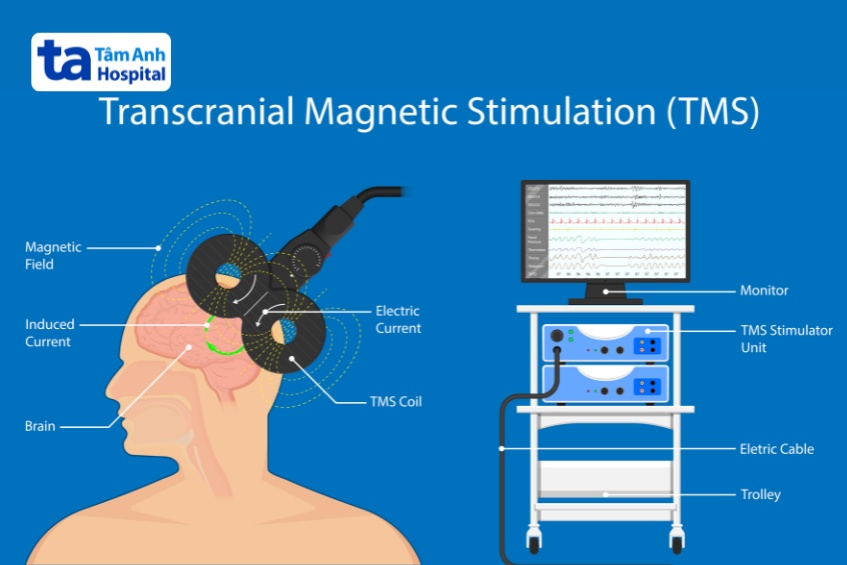 quá trình tms diễn ra theo chỉ định của bác sĩ