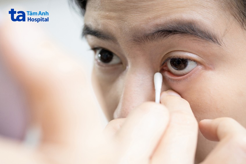 quặm mi khiến người khó chịu