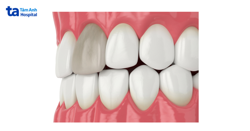 Răng chết tủy đổi màu là gì?