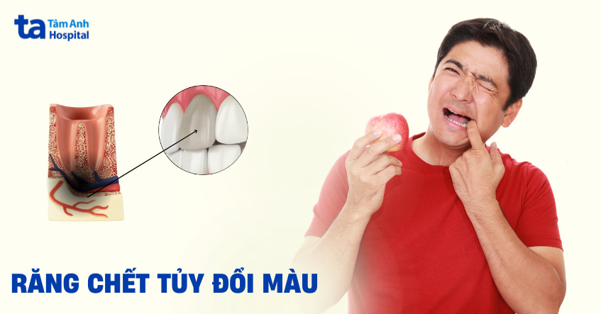 răng chết tủy đổi màu
