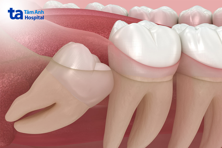 răng hàm đau nhức do răng khôn mọc lệch