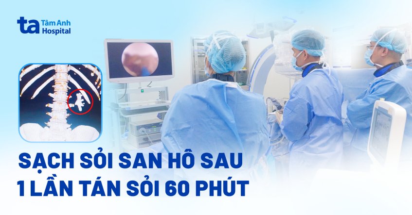 Sạch sỏi san hô sau 1 lần tán sỏi 60 phút