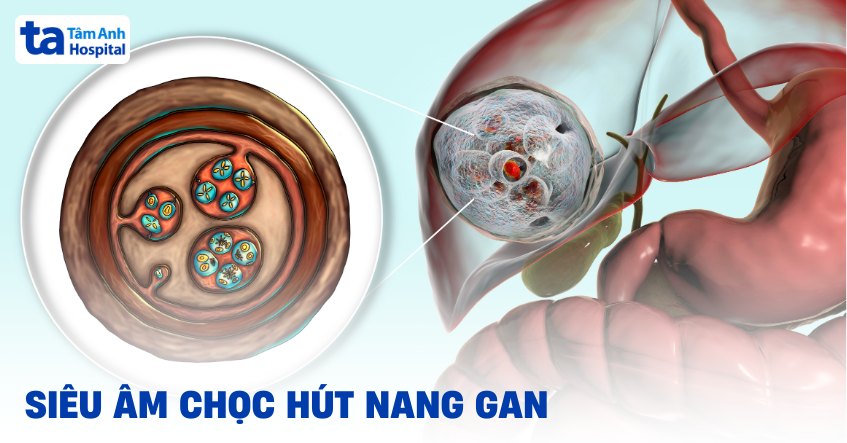 Siêu âm chọc hút nang gan: Quy trình, rủi ro và biến chứng