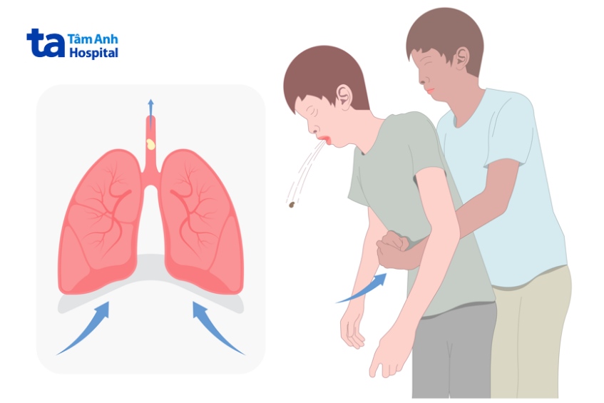 sơ cứu tắc nghẽn đường hô hấp