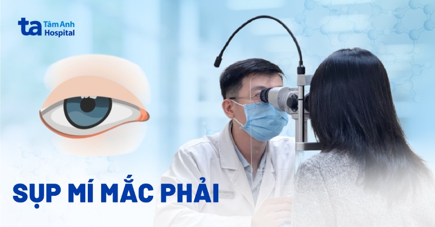 Sụp mí mắc phải: Nguyên nhân, chẩn đoán và phương pháp điều trị