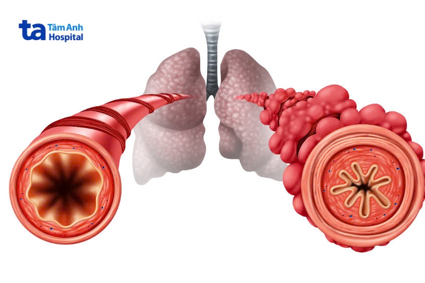 Tắc nghẽn đường hô hấp dưới là tình trạng nguy hiểm