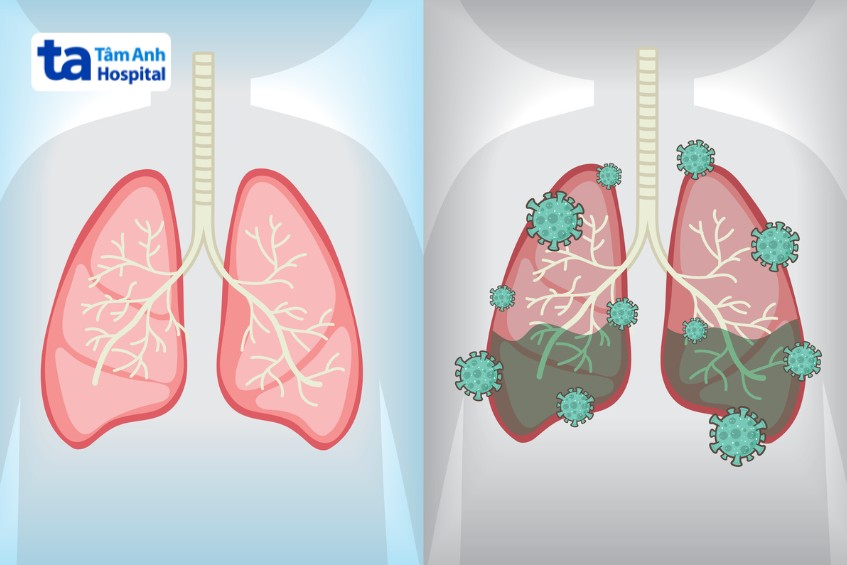 tác nhân gây viêm phổi xâm nhập vào phổi