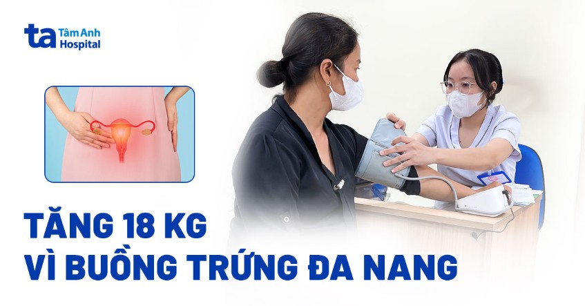 Tăng 18 kg vì buồng trứng đa nang