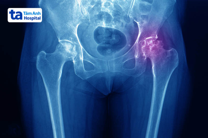 Thoái hóa khớp thường gây đau khớp háng về đêm