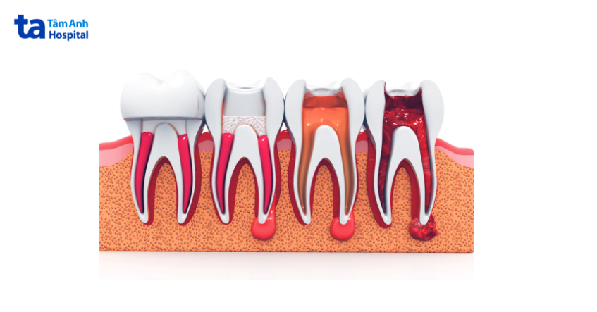 Các giai đoạn dẫn đến thối tủy răng