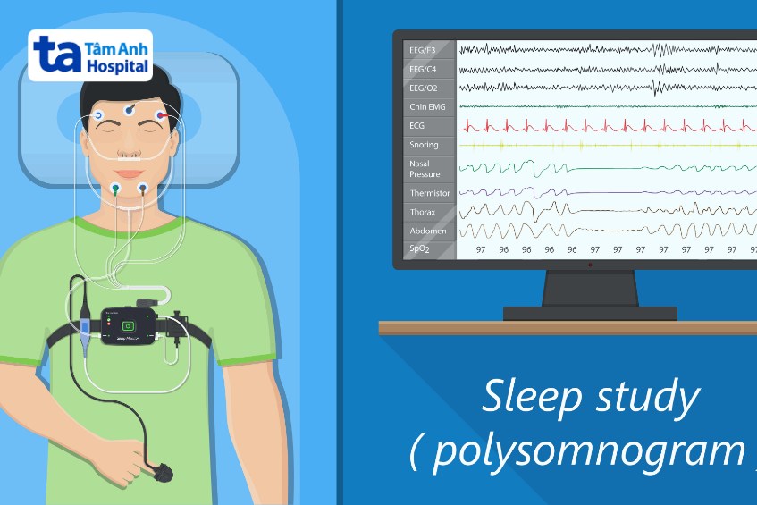 thực hiện đo đa ký giấc ngủ chẩn đoán ác mộng