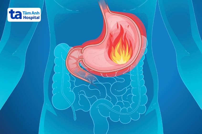 thuốc pantoloc ức chế bơm proton giảm acid dạ dày