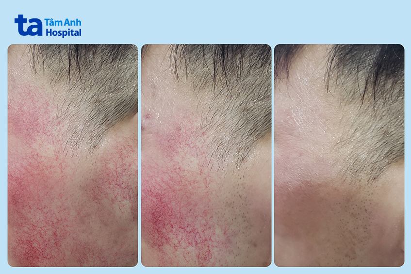 tình trạng giãn mao mạch của anh d