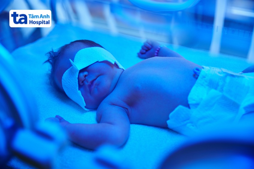 trẻ được đặt dưới ánh sáng xanh, cởi trần, mặc bỉm