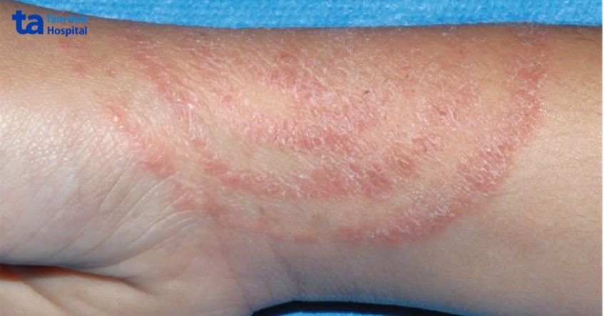 triệu chứng hắc lào