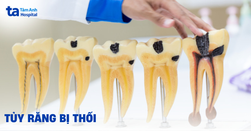 tủy răng bị thối