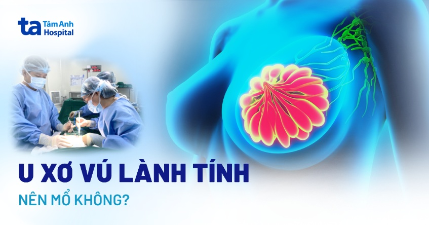 U xơ vú lành tính có nên mổ không? Kích thước bao nhiêu phải mổ?