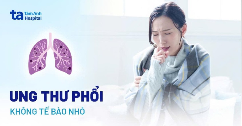 Ung thư phổi không tế bào nhỏ: Nguyên nhân và cách chẩn đoán