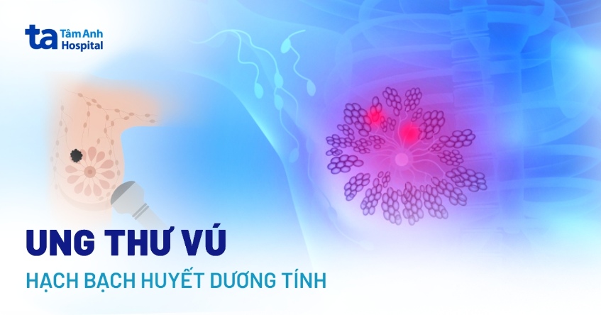 Ung thư vú có hạch bạch huyết dương tính: Chẩn đoán và điều trị