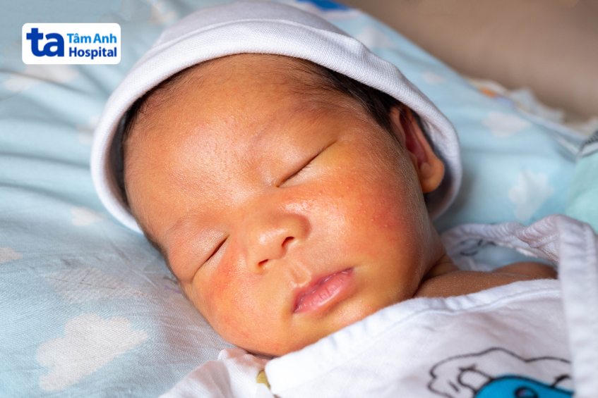 vàng da sơ sinh là một tình trạng thường gặp