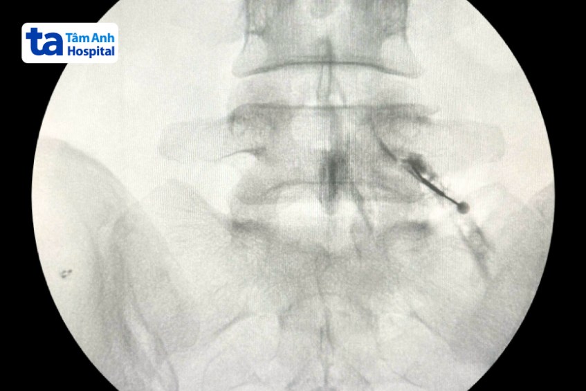 vị trí tiêm của chị kiều