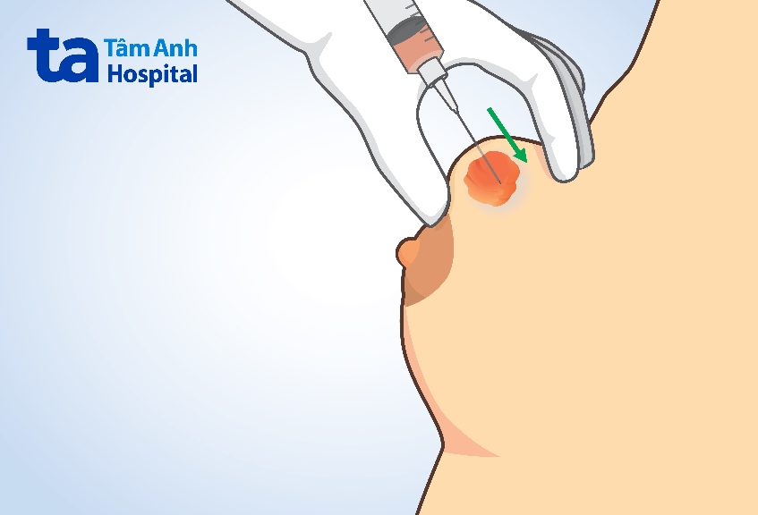 xơ nang tuyến vú cách điều trị