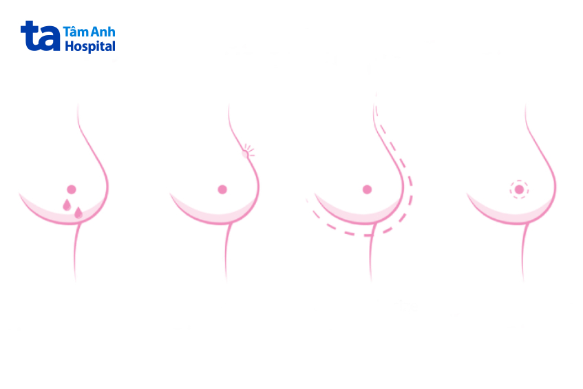 xơ nang tuyến vú có ảnh hưởng gì