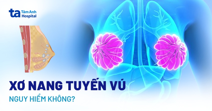Xơ nang tuyến vú có nguy hiểm không? Biến chứng rủi ro là gì?