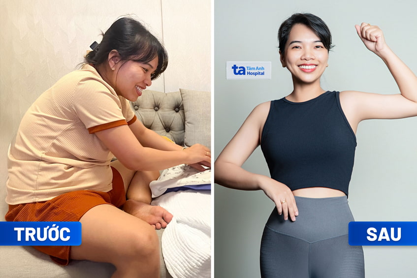 Giảm mỡ hiệu quả tại BVĐK Tâm Anh