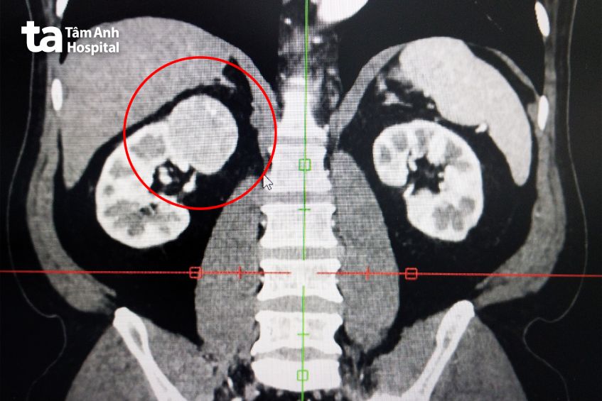 ảnh chụp thấy khối u thận phải
