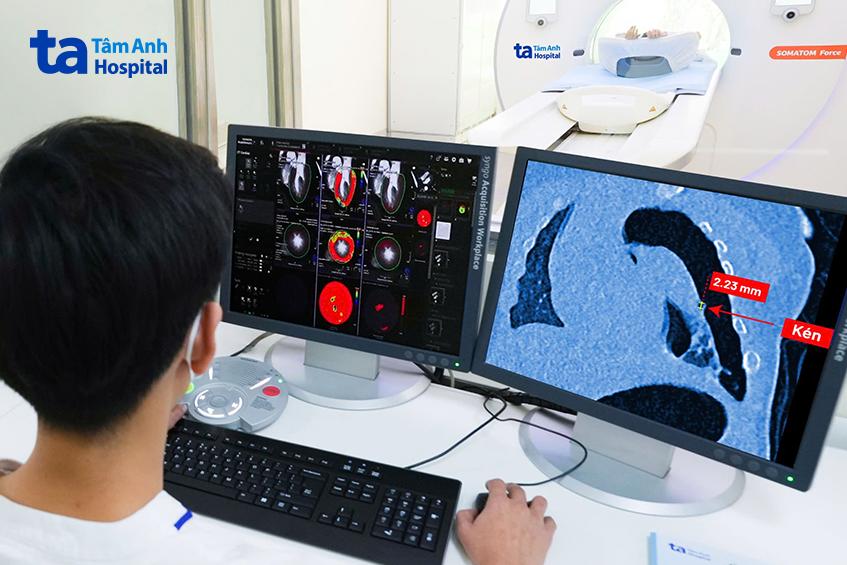 ảnh CT từ máy somatom force vb30
