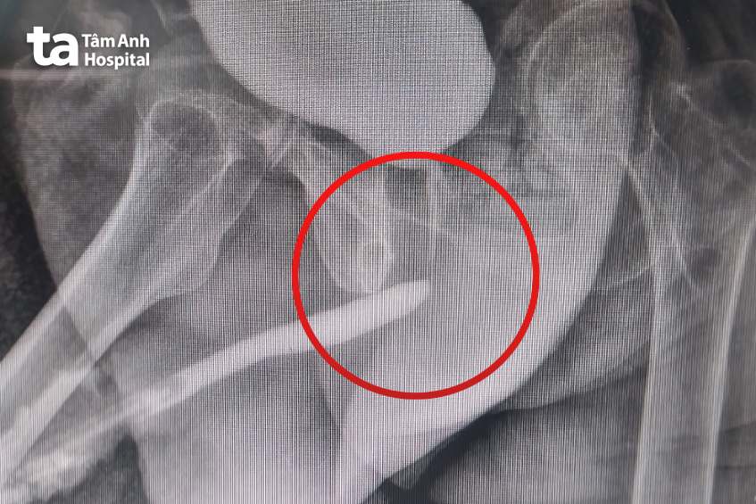 ảnh chụp x-quang niệu đạo ngược dòng