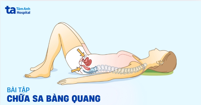 8 bài tập chữa sa bàng quang hiệu quả dễ áp dụng ngay tại nhà