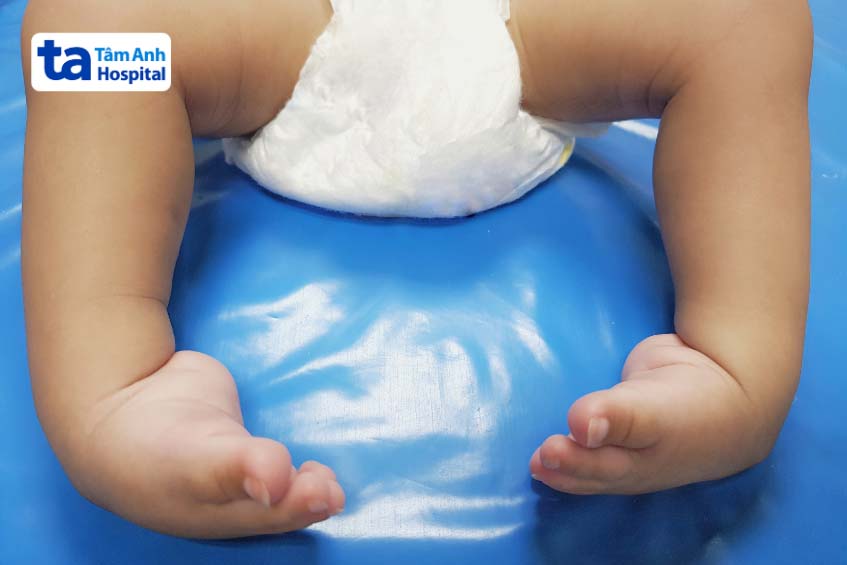 Bàn chân khoèo là dị tật bẩm sinh