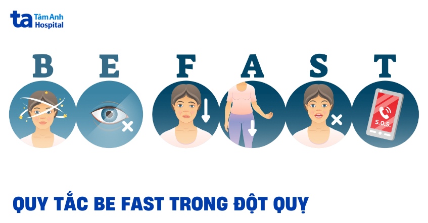 Quy tắc BE FAST trong đột quỵ: Dấu hiệu nhận biết sớm, hiệu quả
