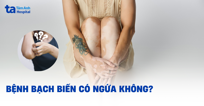 Bệnh bạch biến có ngứa không? Cần lưu ý những điều gì?