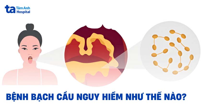 Bệnh bạch hầu nguy hiểm như thế nào? Tác hại và nguy cơ