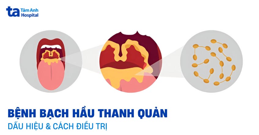 Bạch hầu thanh quản và những thông tin xoay quanh cần nắm