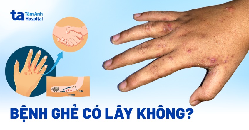 Bệnh ghẻ có lây không? Lây qua đường nào phổ biến?