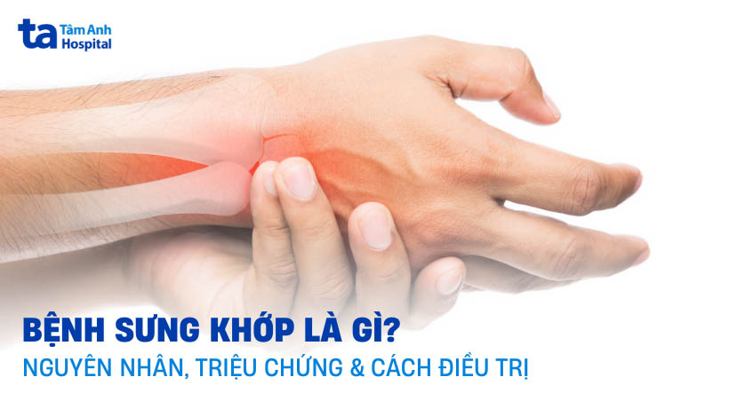 bệnh sưng khớp là gì?
