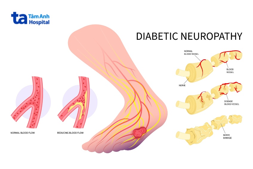 bệnh thần kinh ngoại biên gây hay bị tê chân