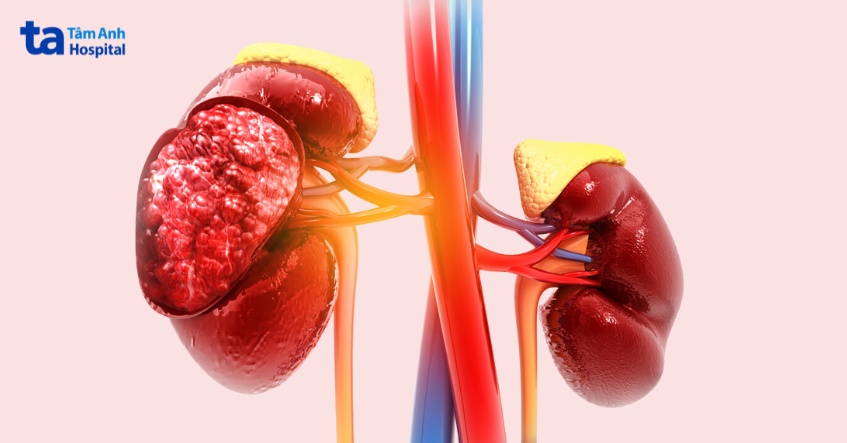 bệnh thận mạn điều trị như thế nào