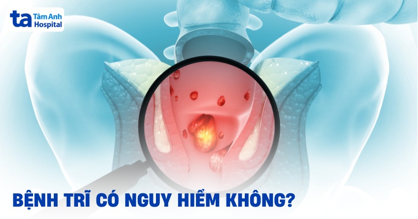 Bệnh trĩ có nguy hiểm không? 6 biến chứng thường gặp