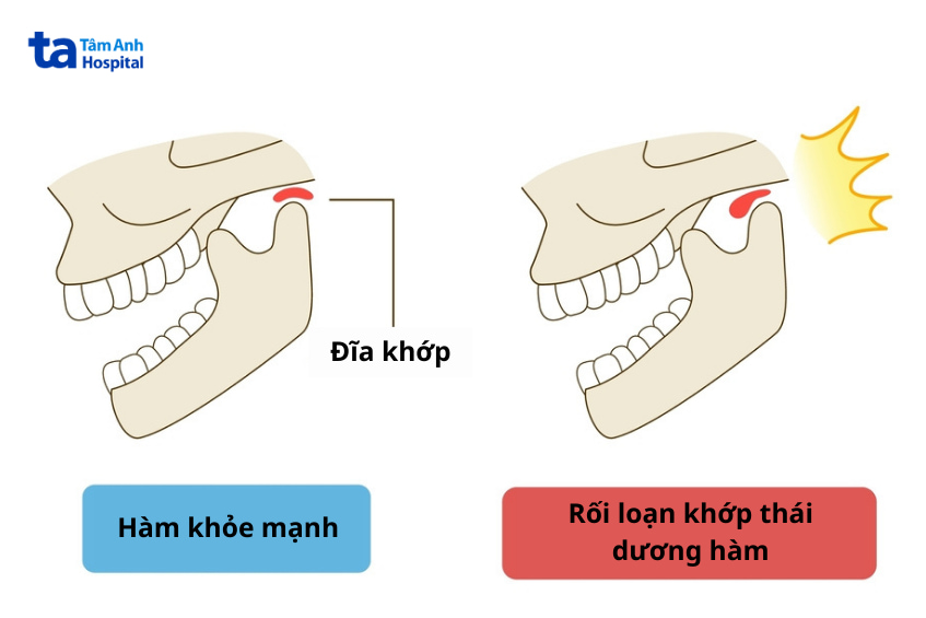 Nguyên nhân đau quai hàm là gì? Rối loạn khớp thái dương hàm