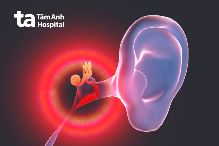 nguyên nhân gây điếc đột ngột