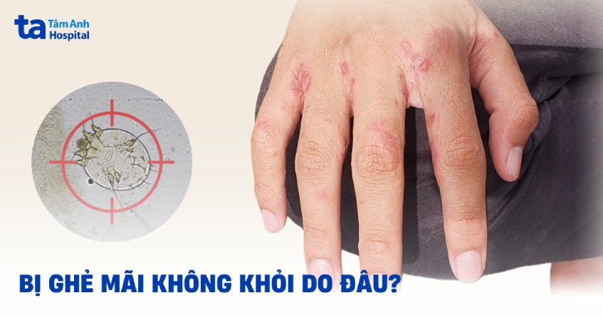 Bị ghẻ mãi không khỏi nguyên nhân do đâu? Yếu tố nào ảnh hưởng?