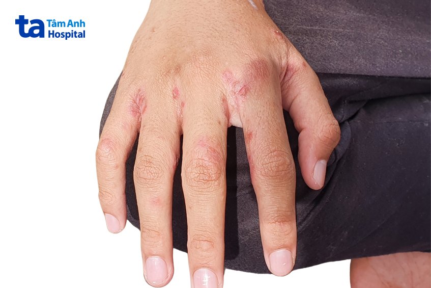 bị ghẻ ở kẽ tay