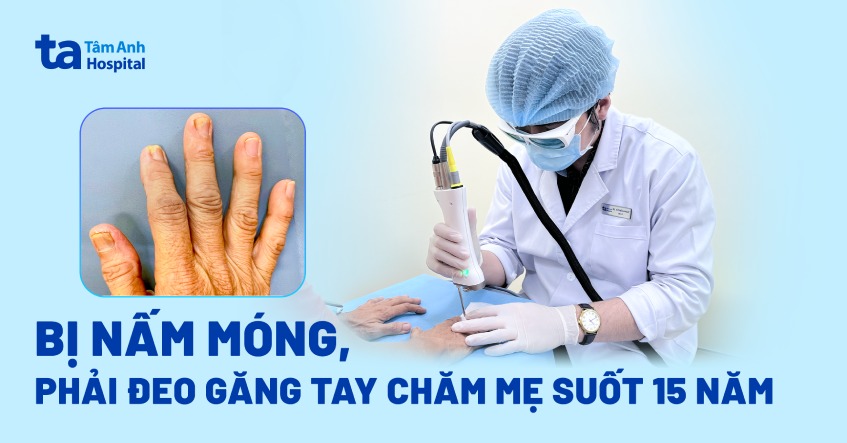 bị nấm móng suốt 15 năm