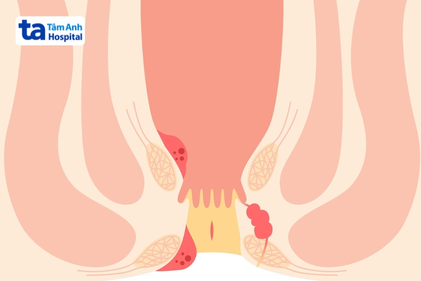 bị sa búi trĩ có gây đau không