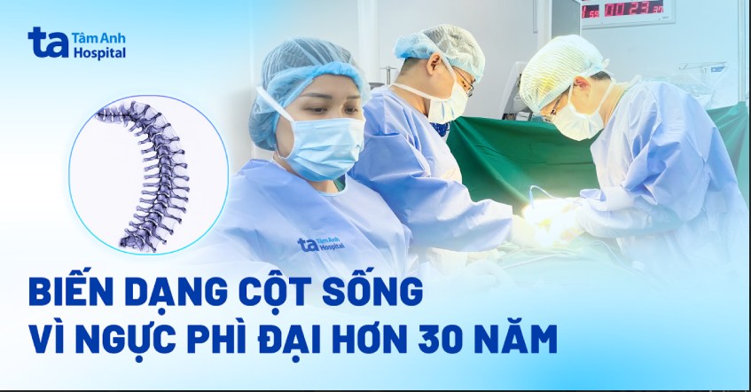 Biến dạng cột sống vì ngực phì đại hơn 30 năm